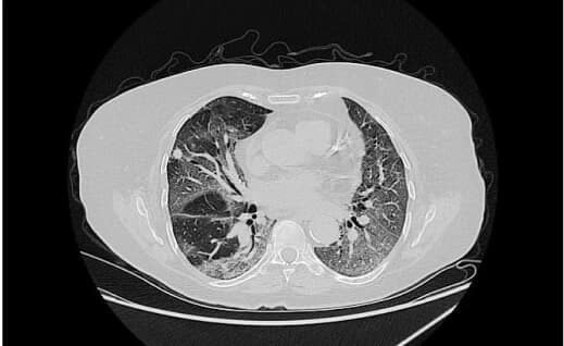 Chest CT